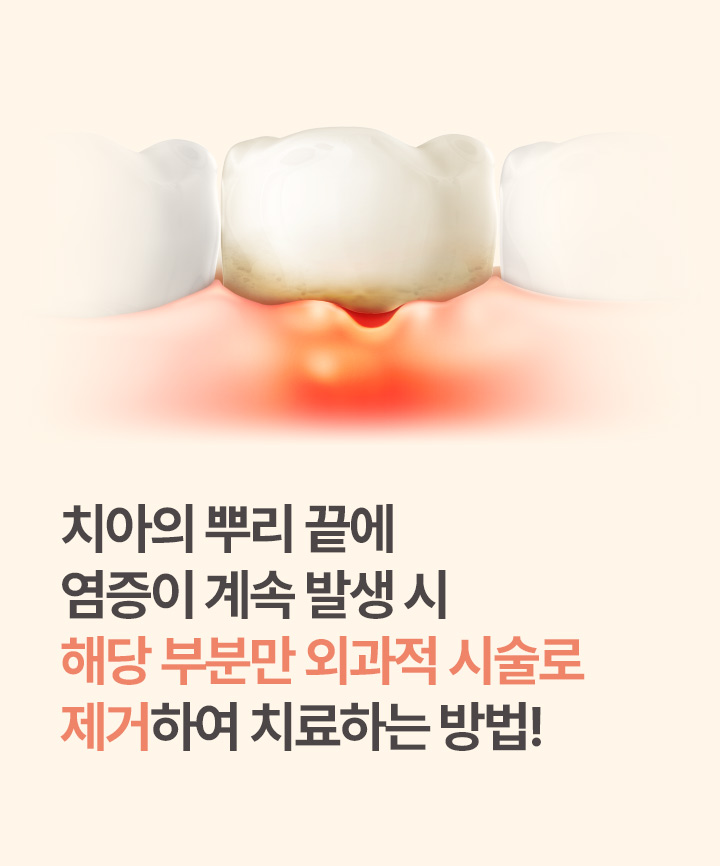 치아의 뿌리 끝에 염증이 계속 발생 시 해당 부분만 외과적 시술로 제거하여 치료하는 방법!