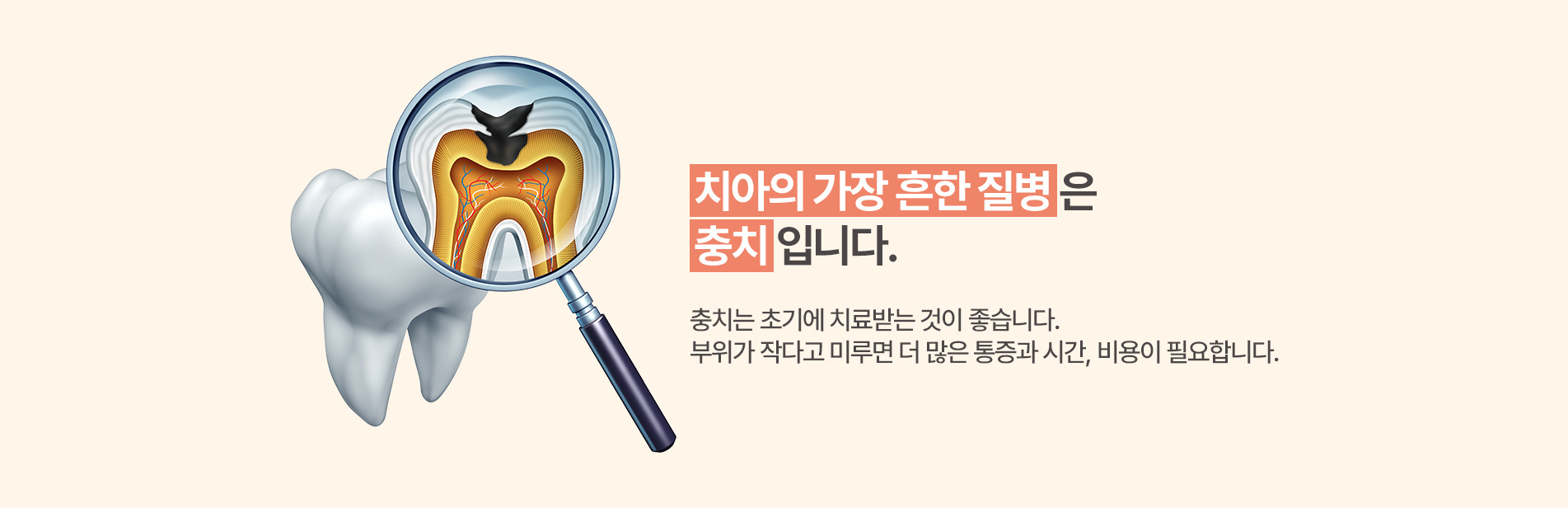 치아의 가장 흔한 질병은 충치입니다.