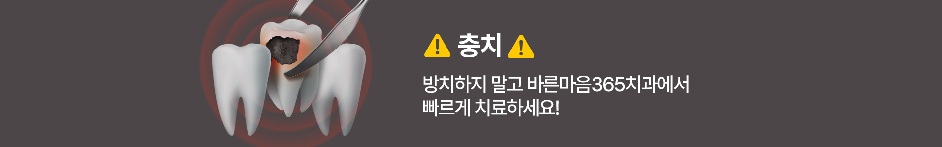 충치 | 방치하지 말고 바른마음 365치과에서 빠르게 치료하세요!