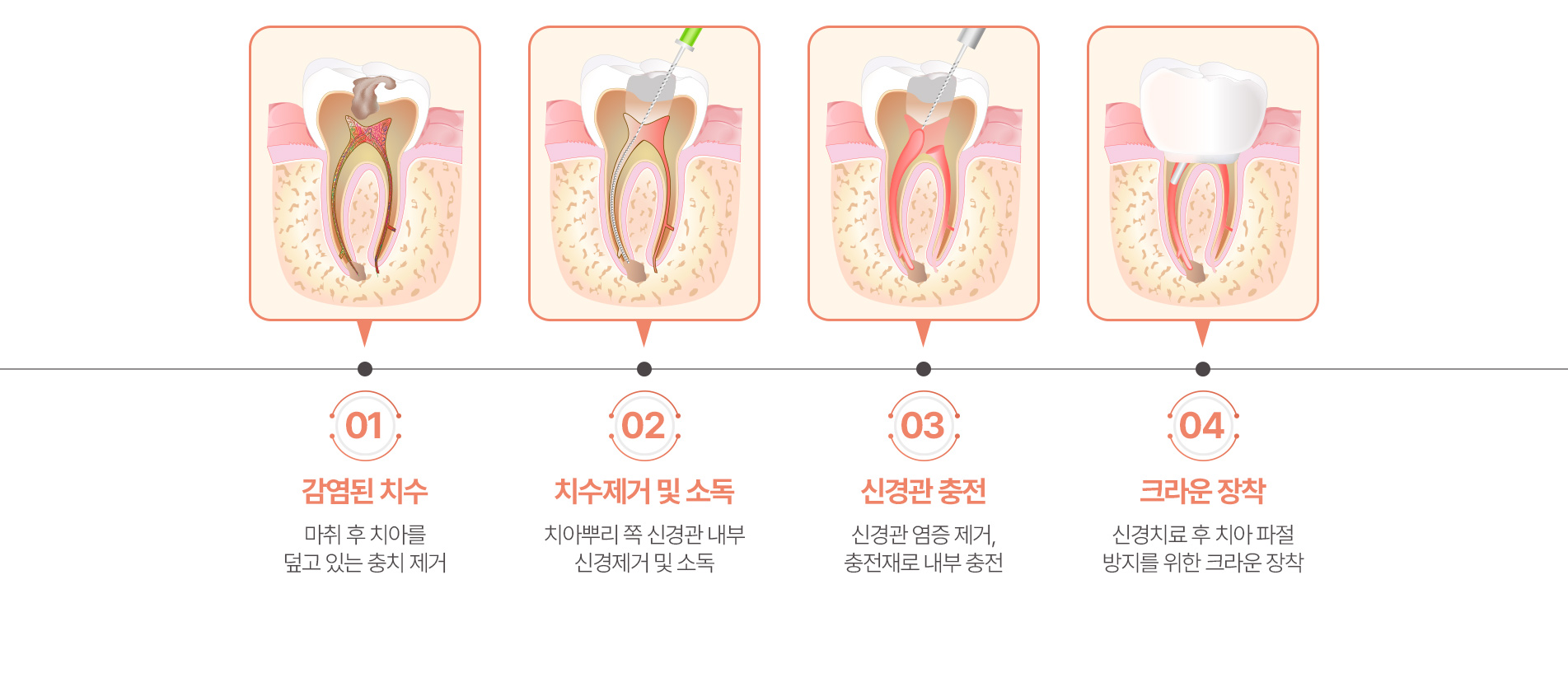 신경치료 단계