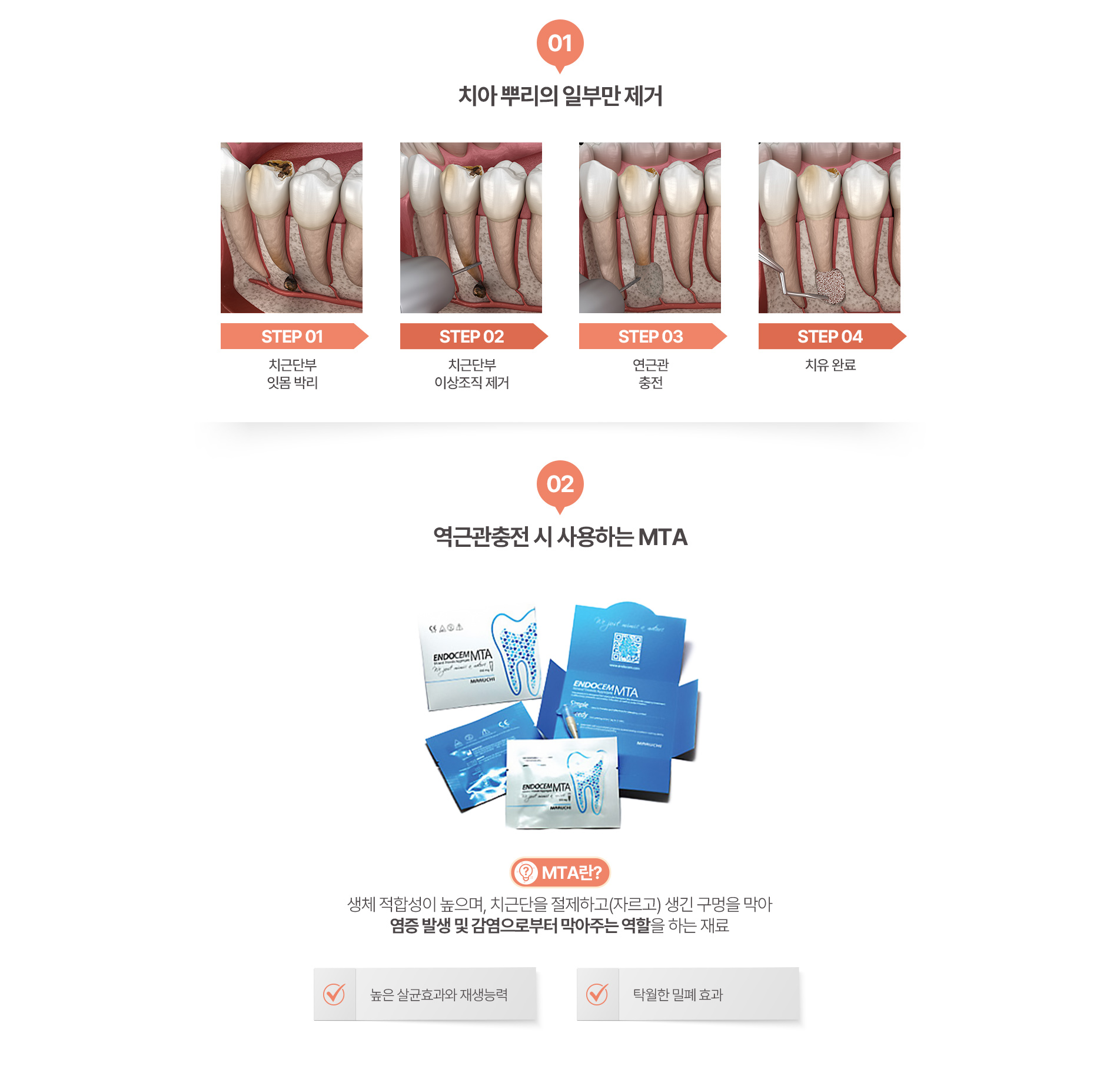 01 치아 뿌리의 일부만 제거 | 02 역근간충전 시 사용하는 MTA