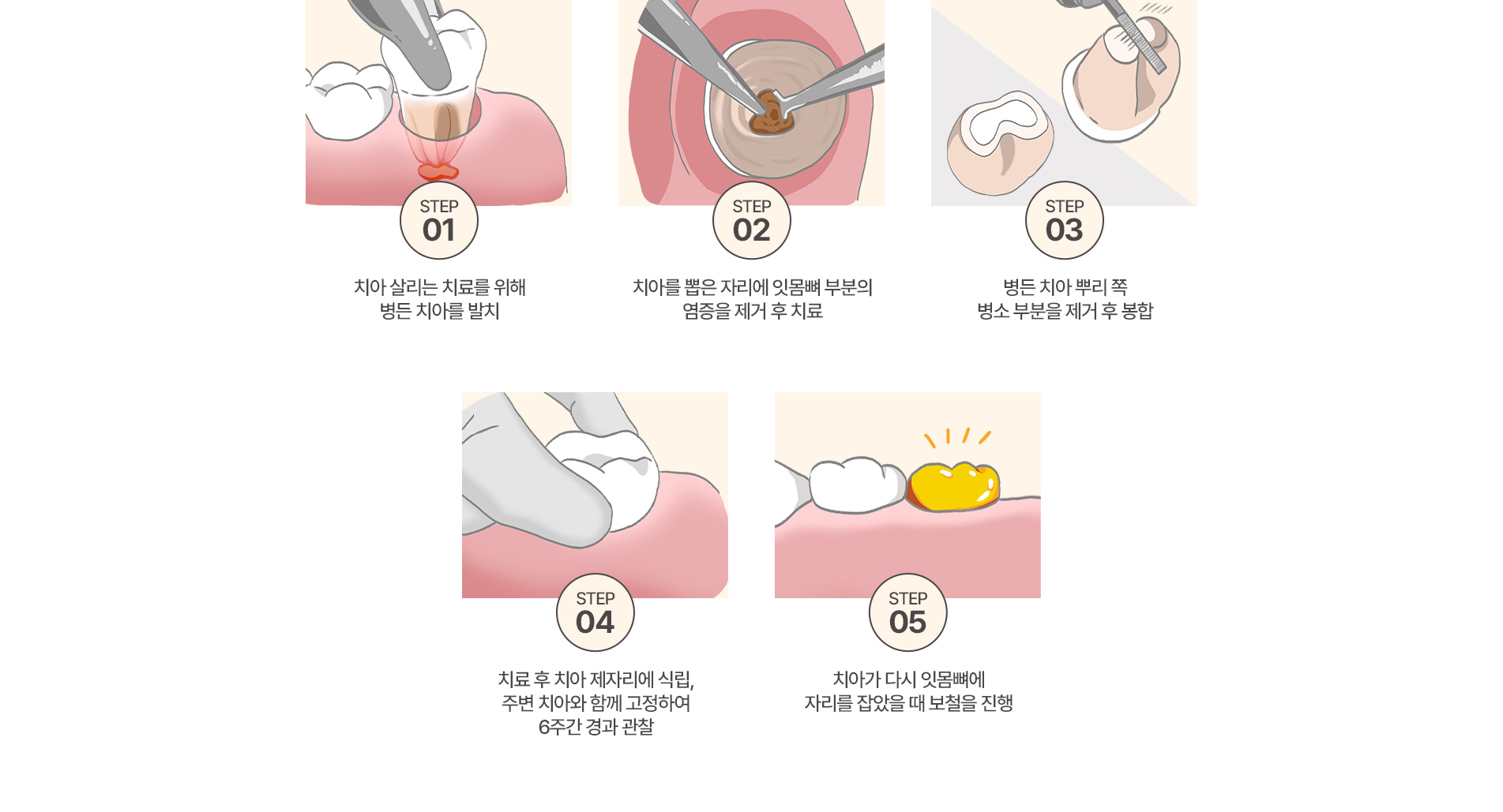 치아재식술 치료과정