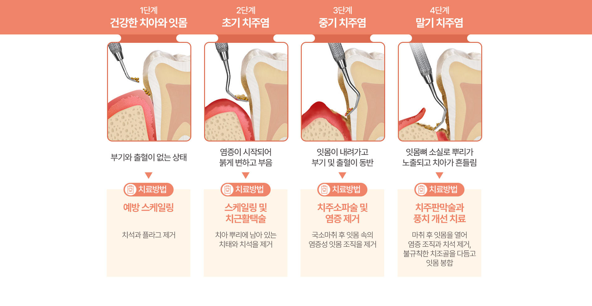 건강한 치아와 잇몸 > 초기 치주염 > 중기 치주염 > 말기 치주염