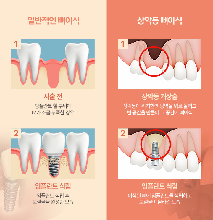 일반적인 뼈이식 | 상악동 뼈이식