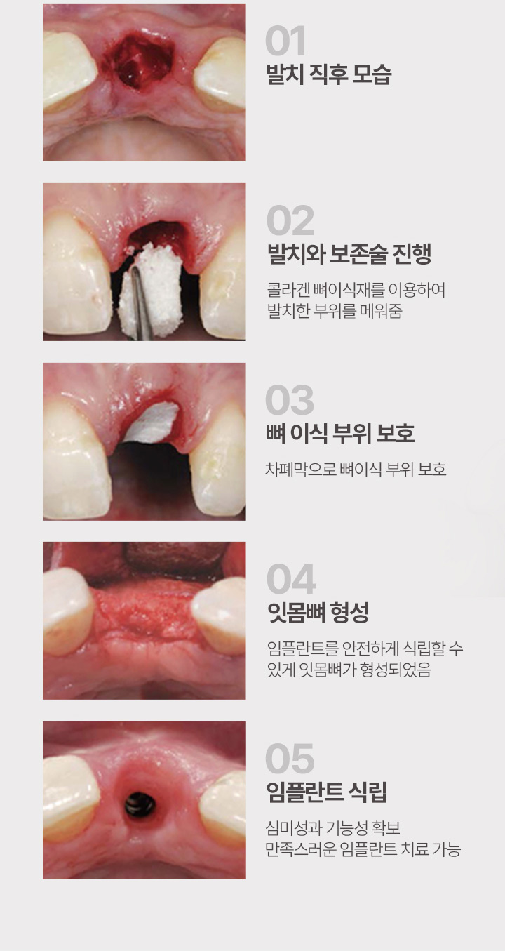 뼈이식 임플란트 치료방법