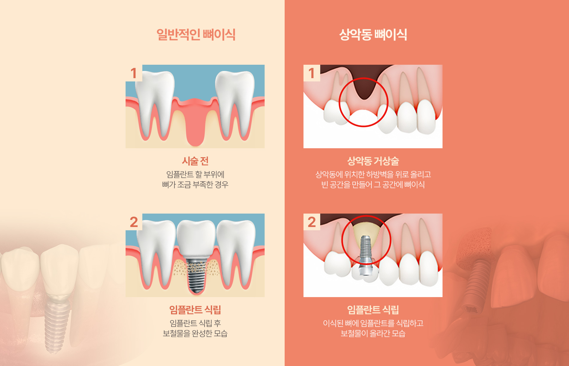 일반적인 뼈이식 | 상악동 뼈이식