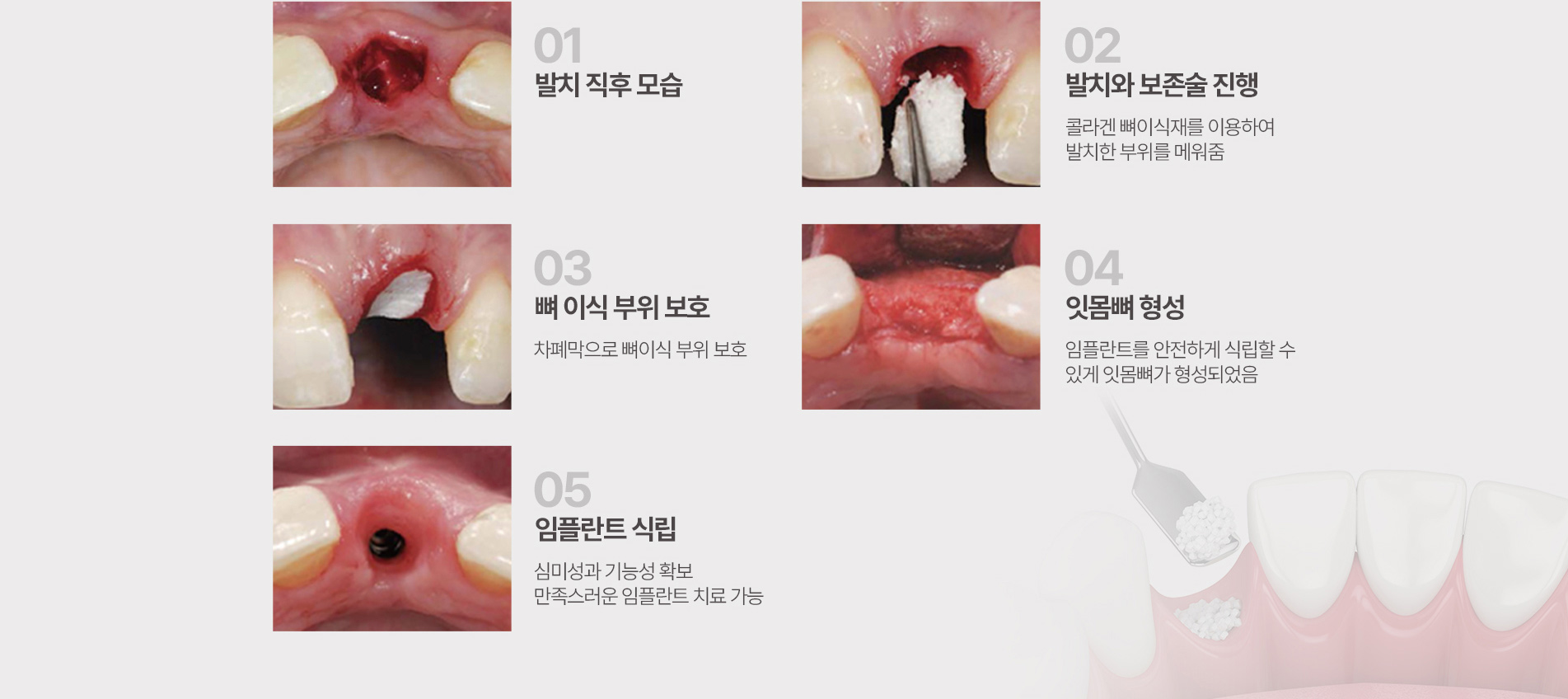 뼈이식 임플란트 치료방법