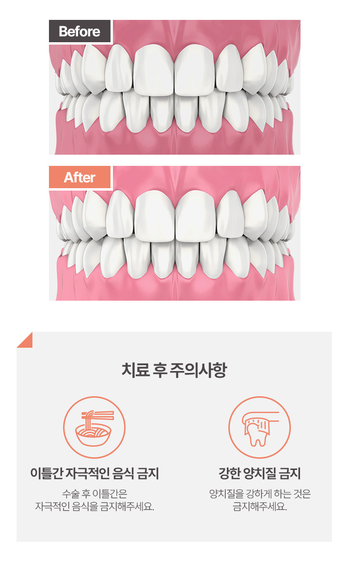 잇몸(치은)미백