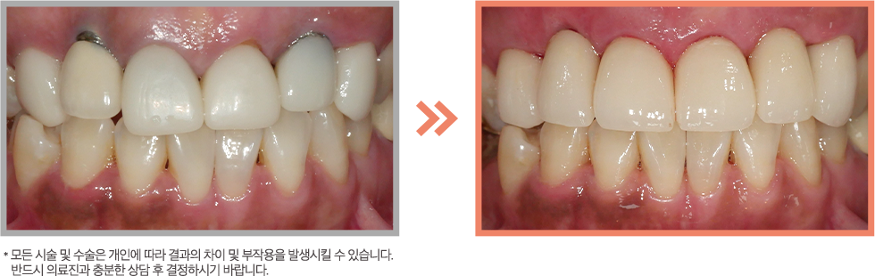 앞니 지르코니아 증례