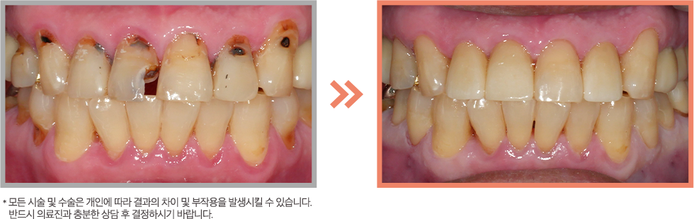 앞니 레진 증례