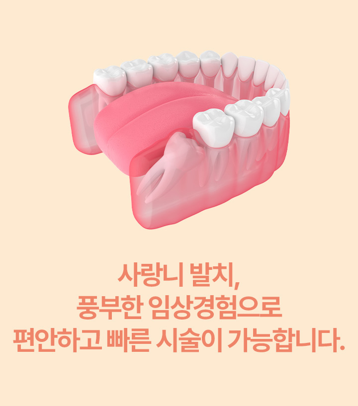 사랑니 발치, 풍부한 임상경험으로 편안하고 빠른 시술이 가능합니다