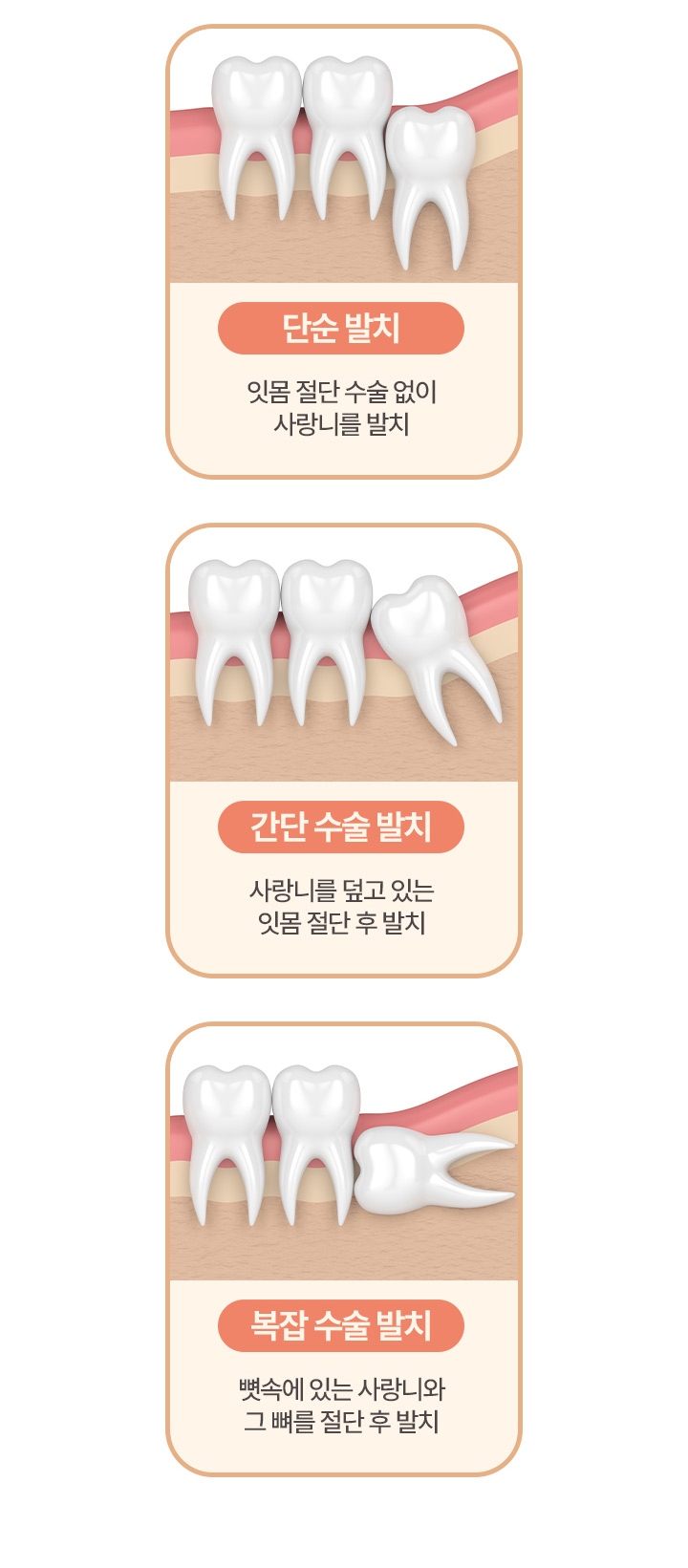 단순 발치 | 간단 수술 발치 | 복잡 수술 발치