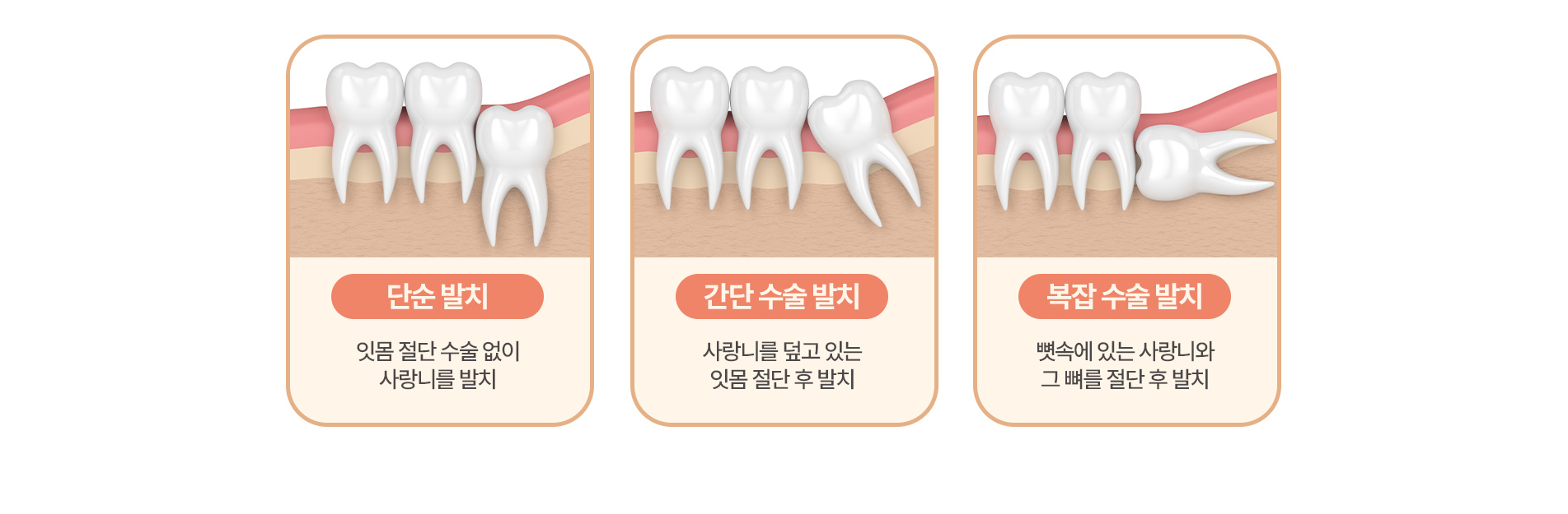 단순 발치 | 간단 수술 발치 | 복잡 수술 발치