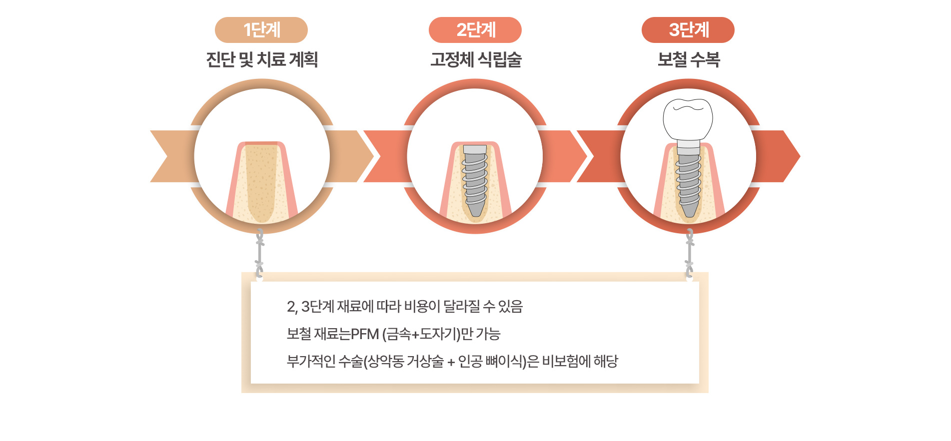 진단 및 치료 계획 > 고정체 식립술 > 보철 수복